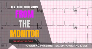 Monitoring Stroke Volume: Understanding Cardiac Output