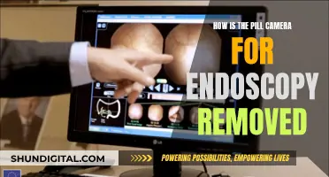 Pill Camera Endoscopy: Removal Process Explained