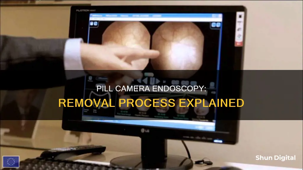 how is the pill camera for endoscopy removed