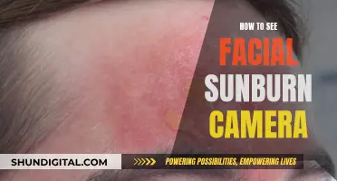 Uncover Sunburn with Camera Technology: What You Need to Know