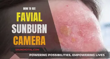 Spotting Facial Sunburn: Camera Lens to the Rescue