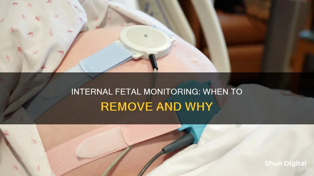 when to remove internal fetal monitoring